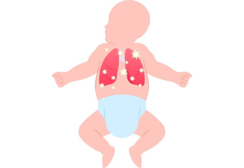 Viêm phổi là biến chứng phổ biến nghiêm trọng nhất của thủy đậu.