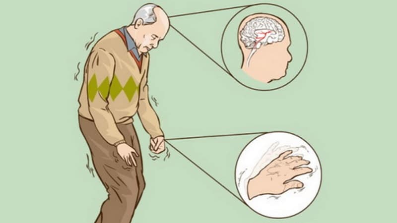 AI cho phép phát hiện bệnh Parkinson
