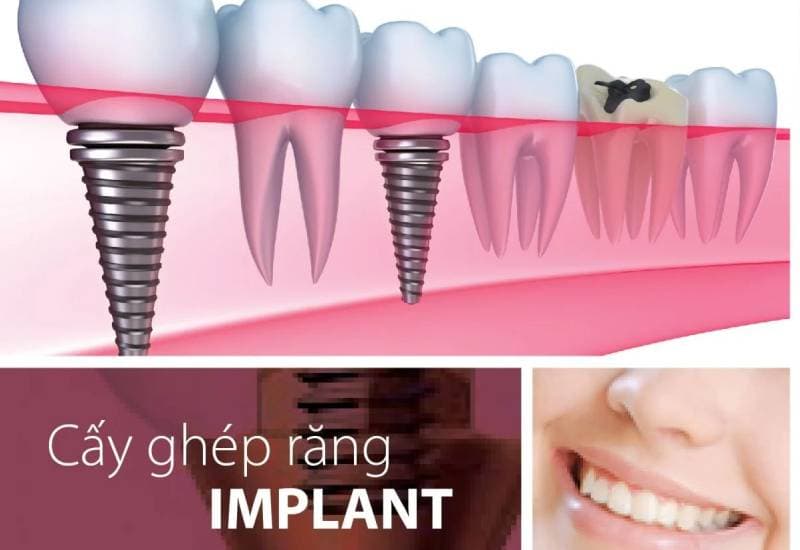 quy trình trồng răng implant như thế nào