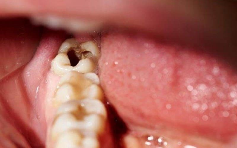 Triệu chứng răng sâu lồi thịt