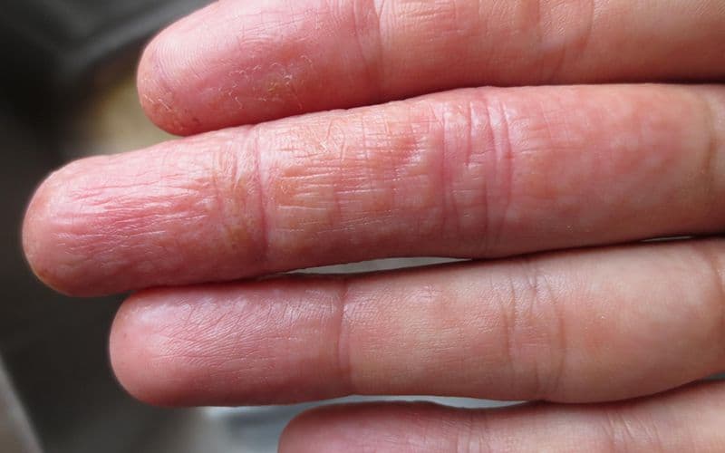 điều trị các vấn đề da như tổ đỉa