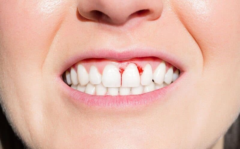 Biểu hiện sưng nướu răng cửa