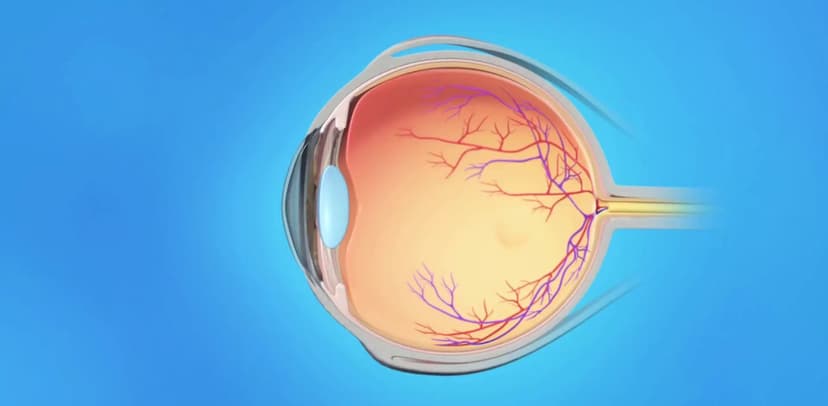 Tân mạch võng mạc: Nguyên nhân, triệu chứng và cách điều trị