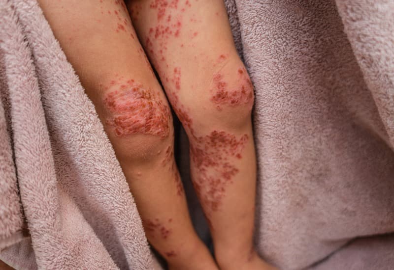 Giải đáp chi tiết thắc mắc: Thời gian ủ bệnh tay chân miệng là bao lâu?