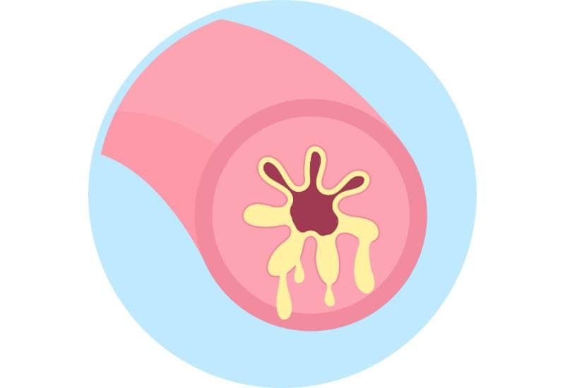 Viêm phế quản là một bệnh lý viêm đường hô hấp phổ biến; bệnh lý này ảnh hưởng đến cả 3 lớp là lớp niêm mạc, lớp cơ trơn và lớp sụn của phế quản.