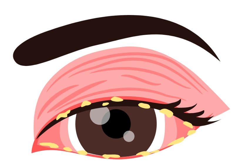 Dấu hiệu nhận biết viêm mí mắt có thể khác nhau tùy thuộc vào nguyên nhân gây bệnh lý này, nhưng có một số dấu hiệu chung mà bạn có thể dễ dàng nhận thấy khi viêm mí mắt dù do bất kỳ nguyên nhân nào