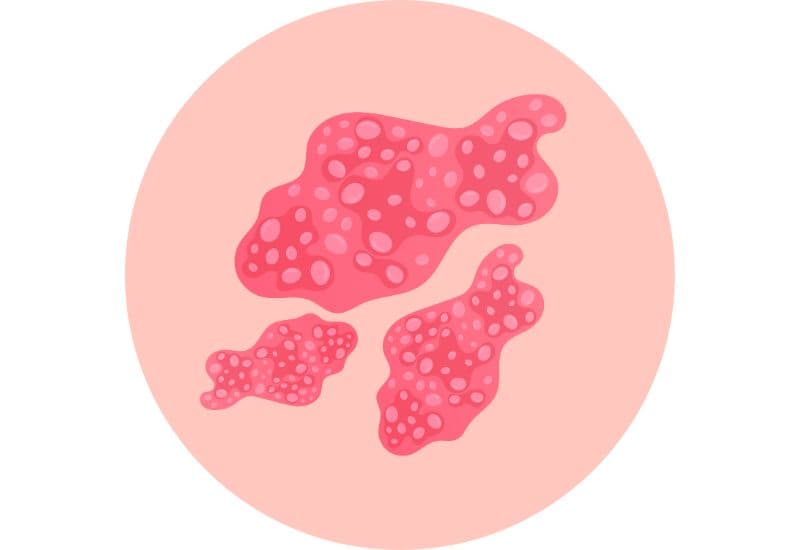 Tổn thương da là triệu chứng dễ nhận biết nhất của thủy đậu.