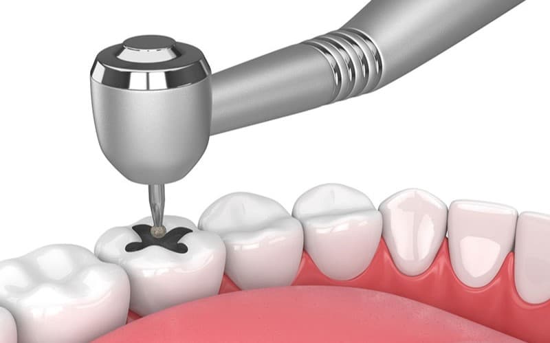 Quá trình trám răng sâu có đau không