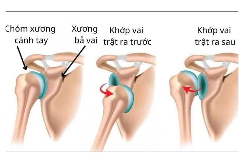 các dạng trật khớp vai