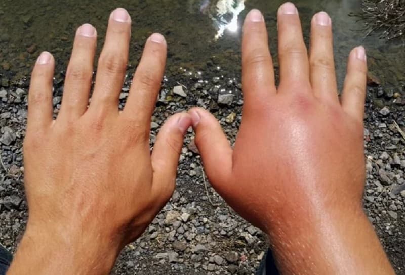 Sử dụng thuốc Menison có thể làm giảm các triệu chứng nào?