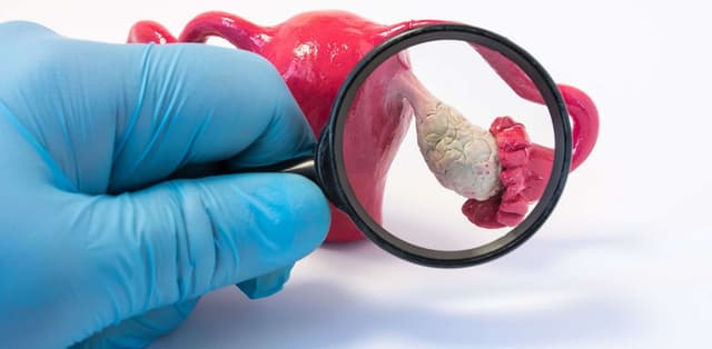 U xơ buồng trứng hay u nang buồng trứng? Tổng quan về bệnh