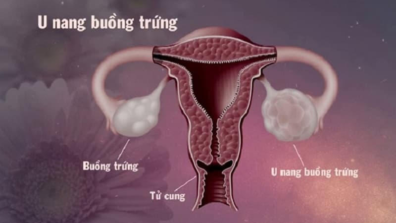 Hình ảnh buồng trứng bình thường và khối u nang buồng trứng
