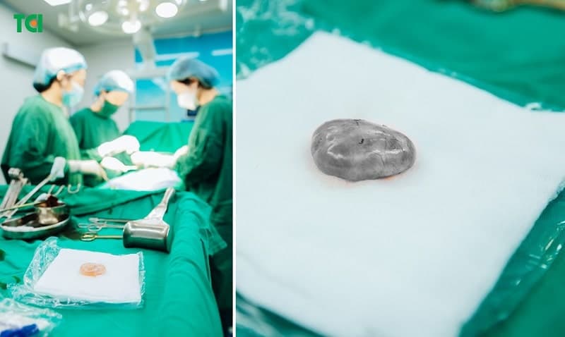 Một ca phẫu thuật lấy thai kết hợp bóc tách khối u nang buồng trứng ở Thu Cúc TCI