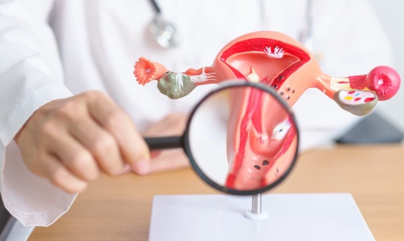 Ung thư cổ tử cung là một bệnh ung thư ác tính phát triển từ các tế bào ở cổ tử cung