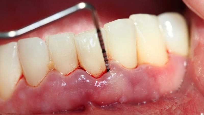 Lấy cao răng chảy máu