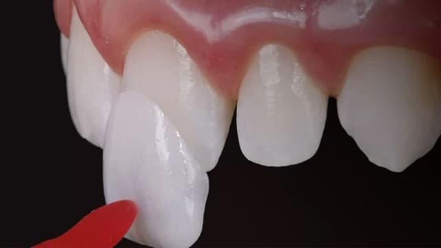 Lợi ích của dán sứ và thông tin chi tiết bảng giá dán sứ Veneer