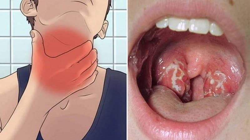 Dấu hiệu bạch hầu đặc trưng là lớp giả mạc ở họng