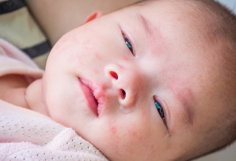 Khi bị bệnh đau mắt đỏ, nhãn cầu mắt bé có gân đỏ