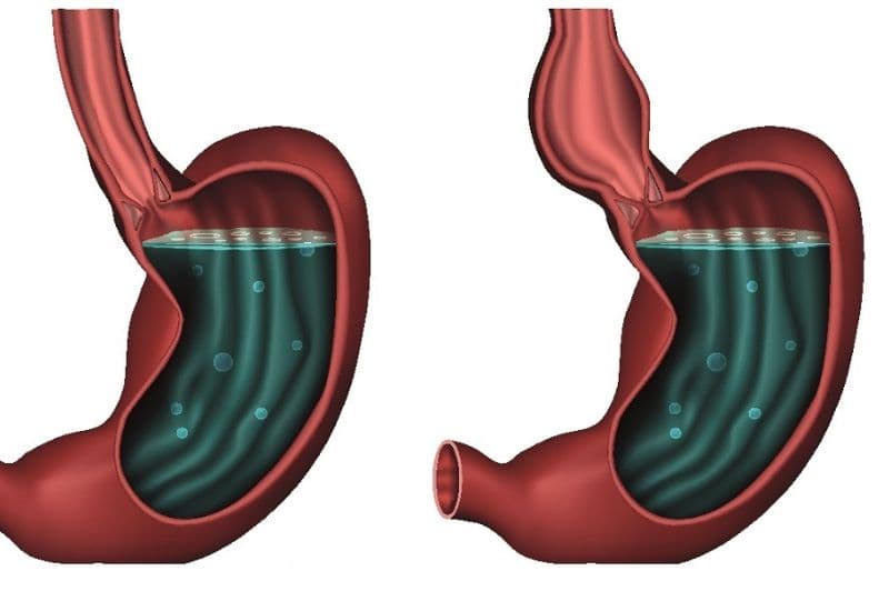 Các bệnh lý thực quản gây đau họng khó nuốt