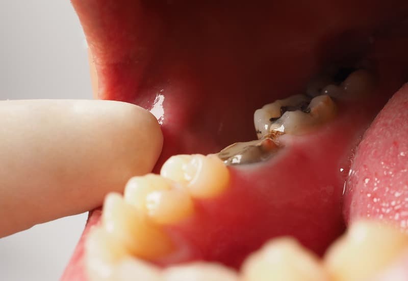 Bệnh sâu răng phát sinh khi acid, được sản xuất từ quá trình vi khuẩn phân hủy thức ăn thừa, tấn công men răng.