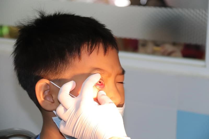 Nên đeo gang tay đã khử trùng khi sờ vào mắt người bị đau mắt đỏ