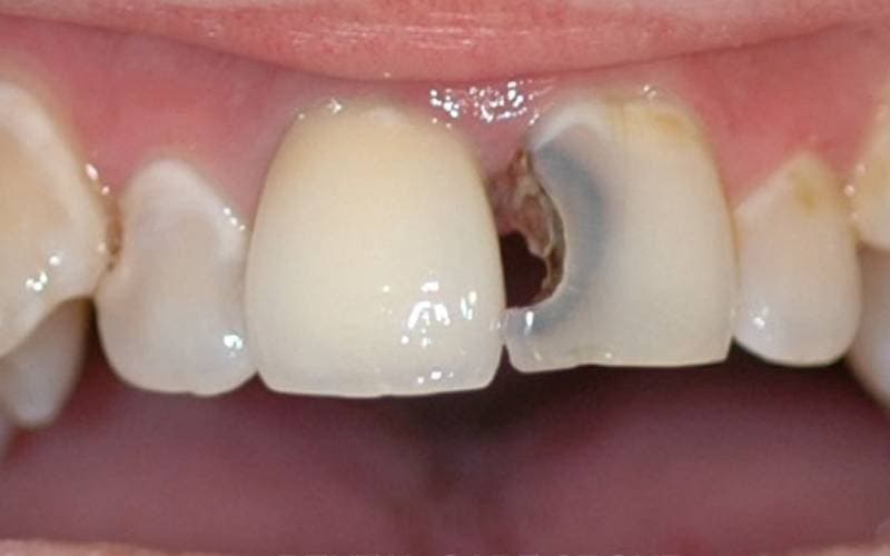 bị sâu răng cửa nguy hiểm không