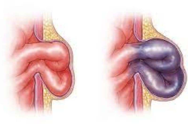 biến chứng thoát vị bẹn nếu không điều trị