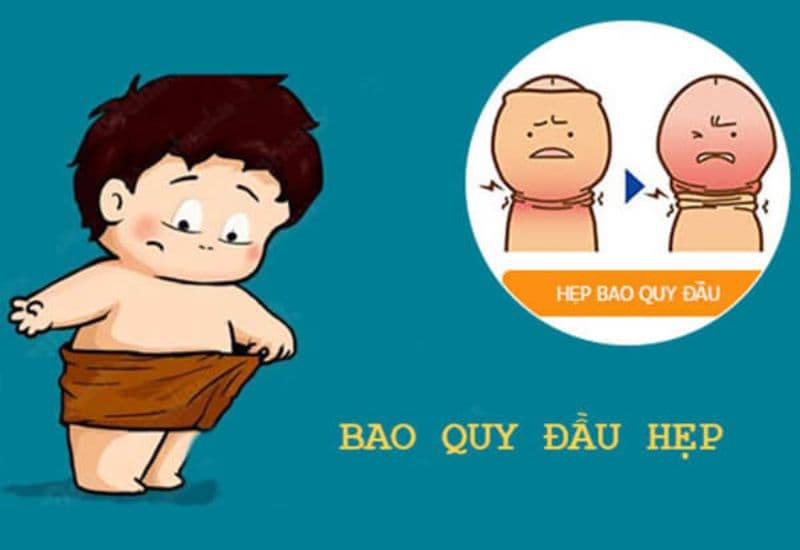 biểu hiện hẹp bao quy đầu