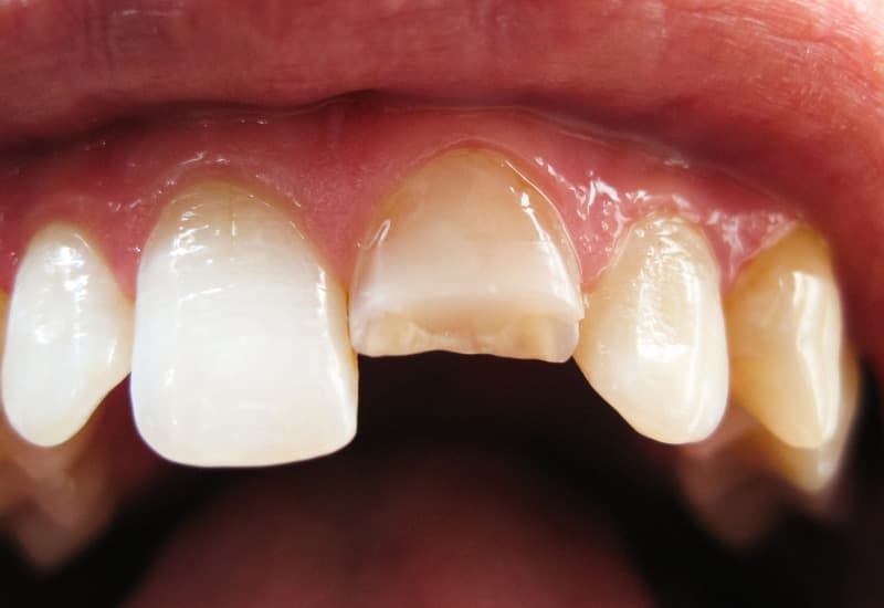 Giải đáp thắc mắc chi tiết: Bọc răng sứ 1 chiếc được không?