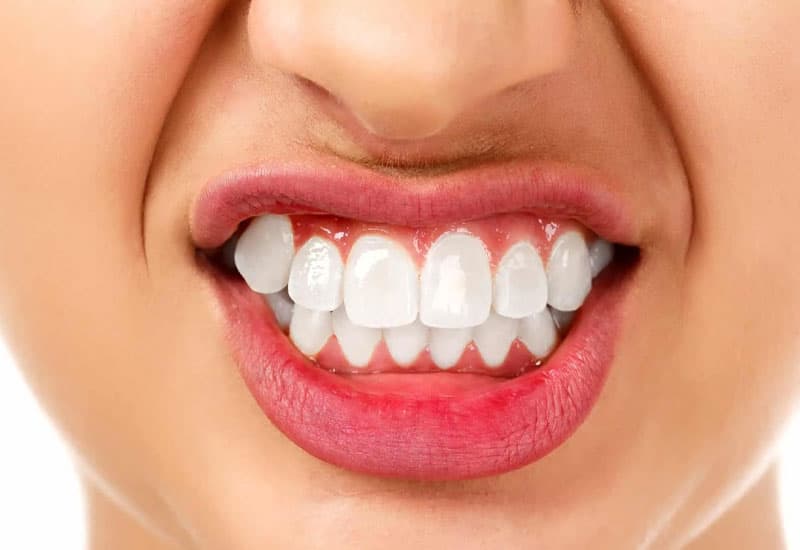 bọc răng sứ 2 răng cửa bị hô hiện nay