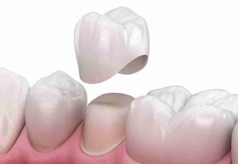 giải đáp Bọc răng sứ có đau không