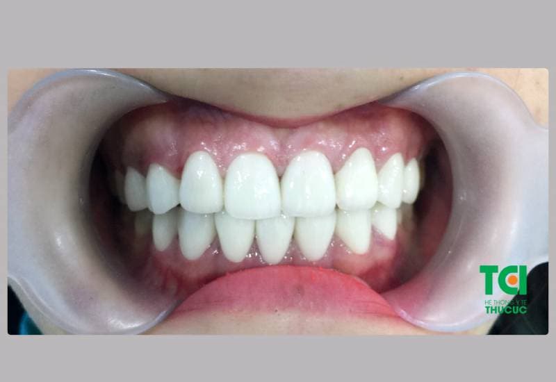 Bọc răng sứ có đau không hả bác sĩ