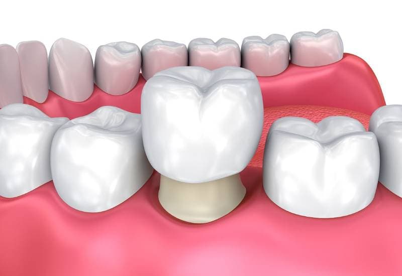 bọc răng sứ được bao lâu vậy