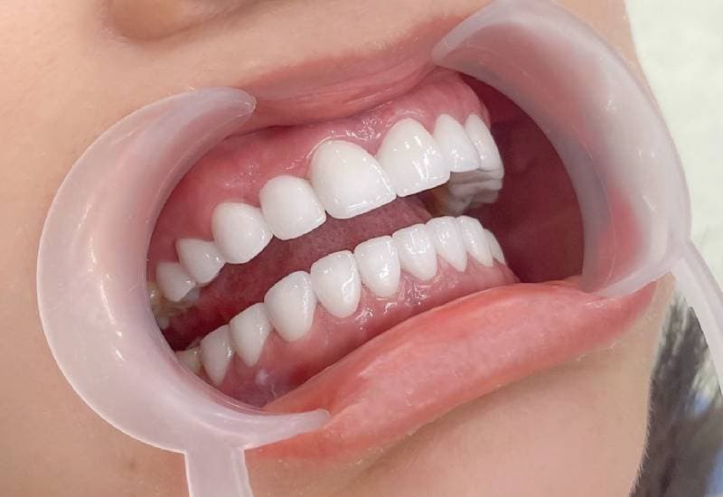 hỏi về bọc răng sứ được bao lâu