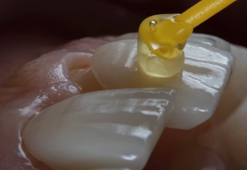 Bọc răng sứ veneer là phương pháp thẩm mỹ nha khoa hiện đại, sử dụng các miếng dán mỏng được chế tác từ sứ cao cấp để cải thiện hình dạng, màu sắc của răng. 