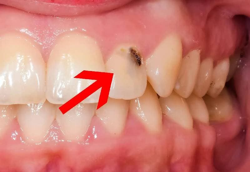 hỏi cách chữa răng cửa bị sâu