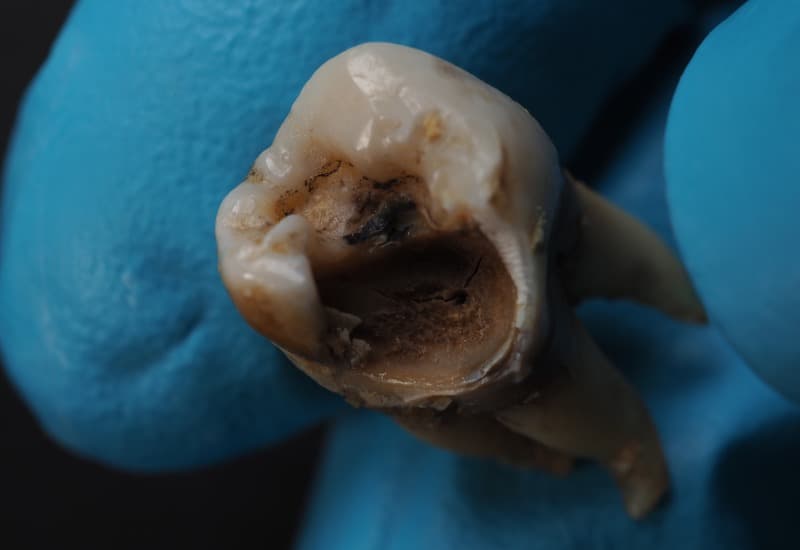 Áp xe nếu tiếp tục không được điều trị, cấu trúc răng có thể suy yếu đến mức gãy hoặc rụng. 