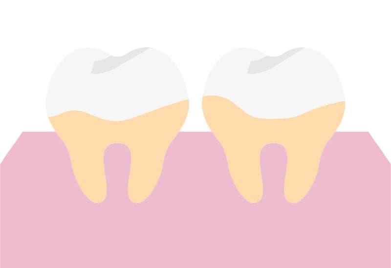 Cao răng là lớp cứng bám chặt trên bề mặt răng, thường ở gần nướu. 