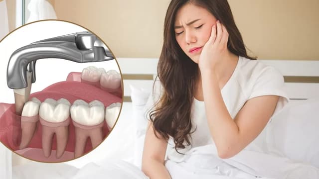 Cập nhật chi phí nhổ răng khôn hiện nay