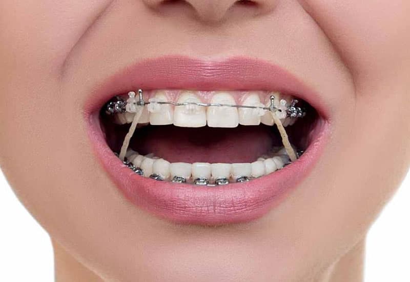 tư vấn Chỉnh nha niềng răng