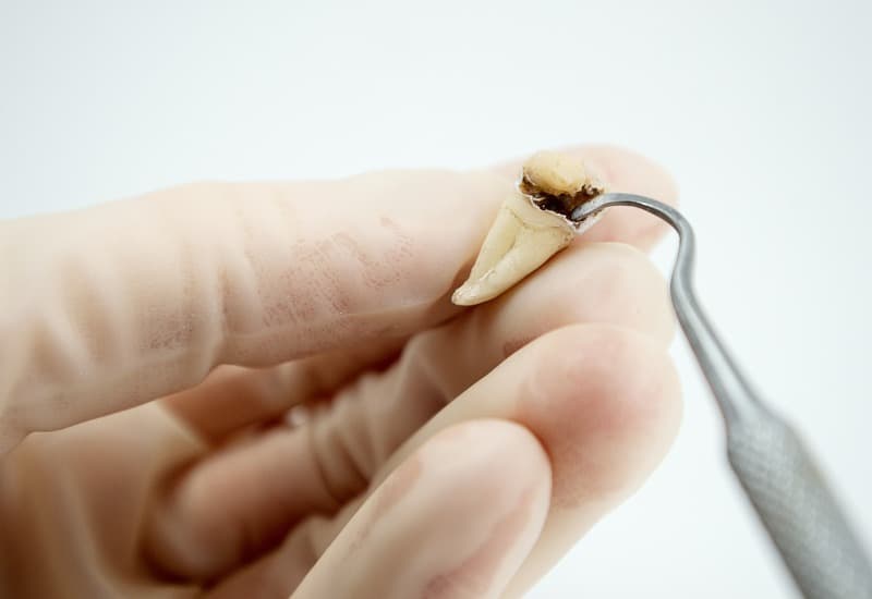 Khi sâu răng tiến triển, bề mặt răng có thể hình thành lỗ nhỏ. 