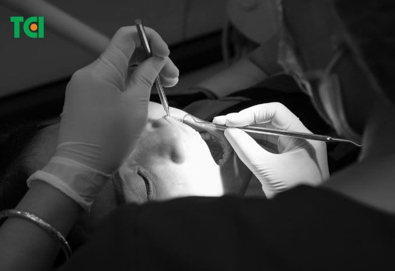 Nếu sâu răng đã ảnh hưởng đến tủy răng, bác sĩ sẽ tiến hành lấy tủy. 