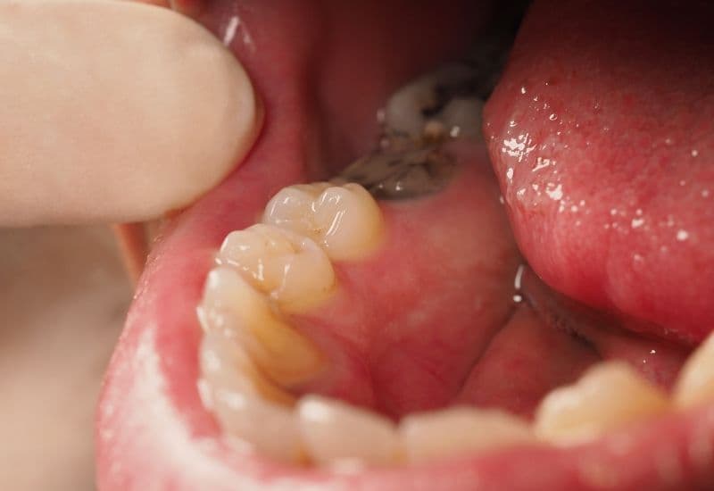 Răng sâu lồi thịt là tình trạng răng sâu nặng, dẫn đến tổn thương nghiêm trọng lớp ngà răng và có thể ảnh hưởng đến cả lớp tủy răng.