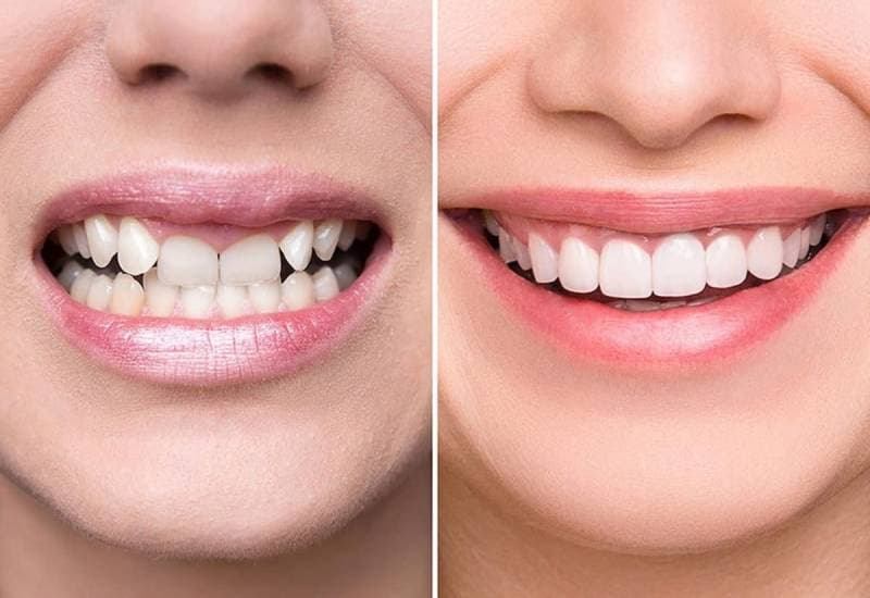 Có nên bọc răng sứ không các bạn