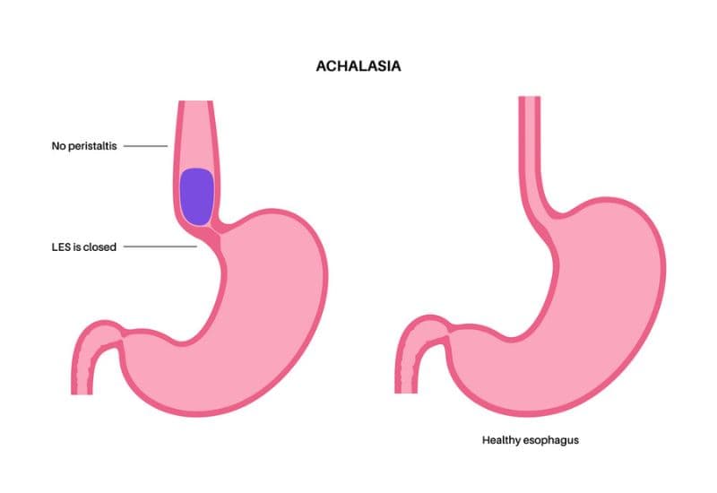 Nuốt nghẹn đau ngực cảnh báo bệnh Achalasia