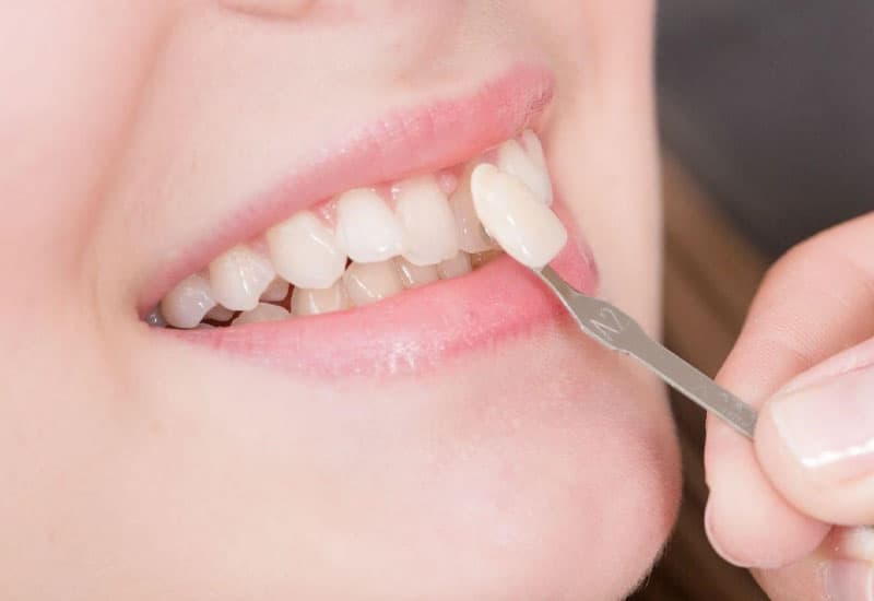 Dán sứ Veneer giá bao nhiêu 1 răng, có tốt không 