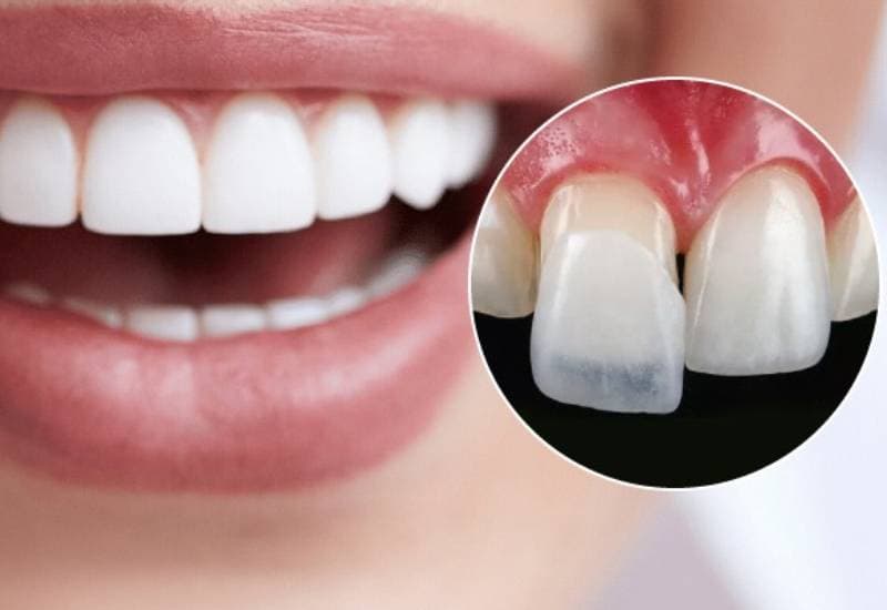 Dán sứ veneer là gì bác sĩ