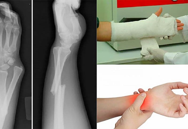 triệu chứng gãy xương cánh tay