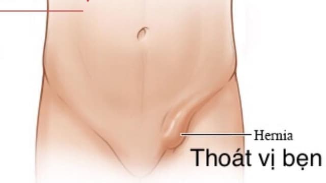 Dấu hiệu thoát vị bẹn: Nhận biết sớm để xử trí kịp thời