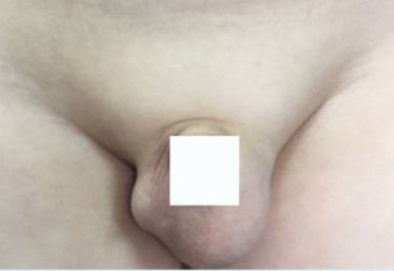 dấu hiệu thoát vị bẹn